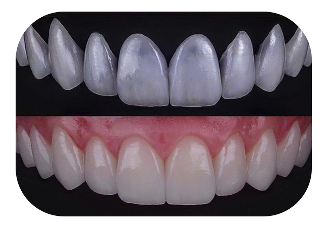 EMAX LAMINATE VENEERS