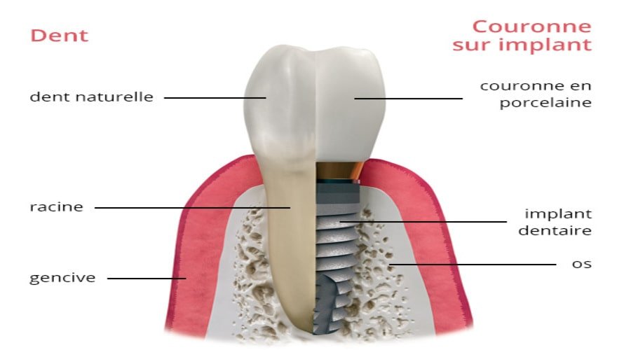 implant-comparaison-couronne-min