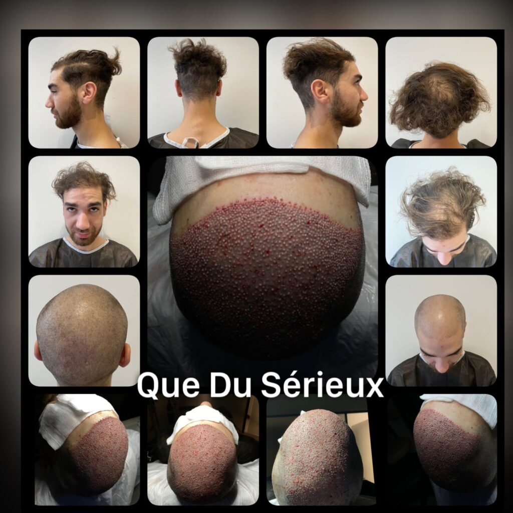 https://cliniquedentalimplant.com/greffe-de-cheveux-en-turquie/