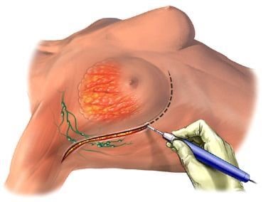 Implants mammaires Turquie