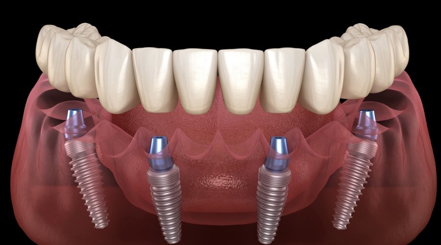 l'implant All-on-4 en Turquie