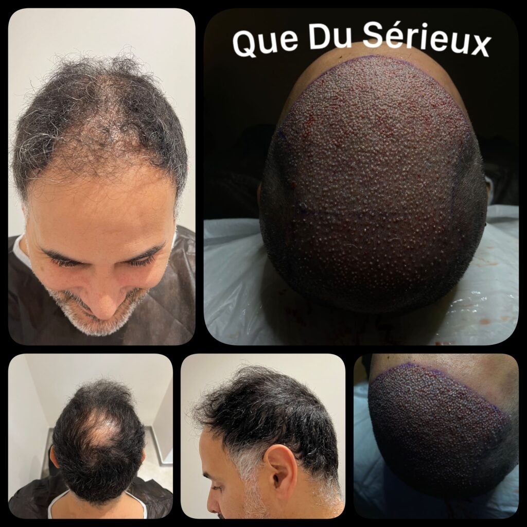 https://cliniquedentalimplant.com/greffe-de-cheveux-en-turquie/