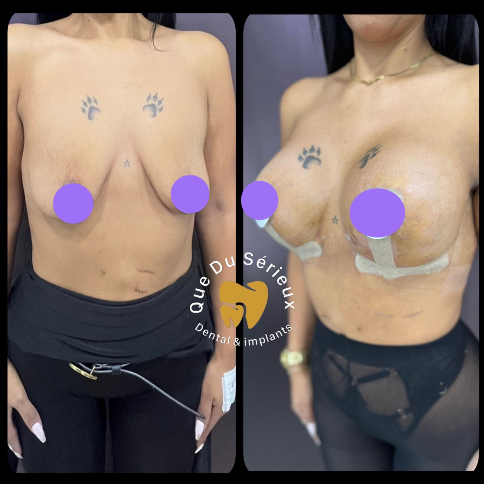 implants mammaires 450 cc