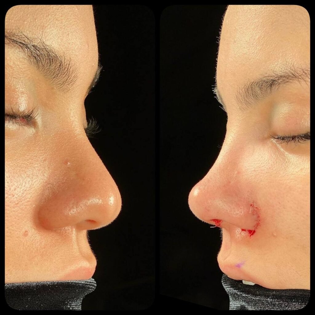 Rhinoplasty Before and After