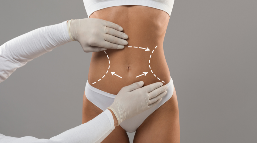 prix abdominoplastie