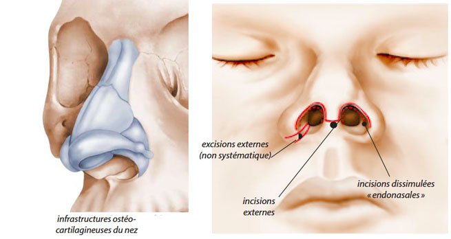 Rhinoplasty Before and After