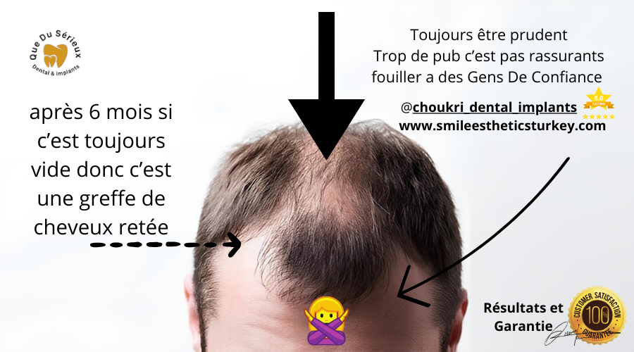 greffe-de-cheveux-ratee