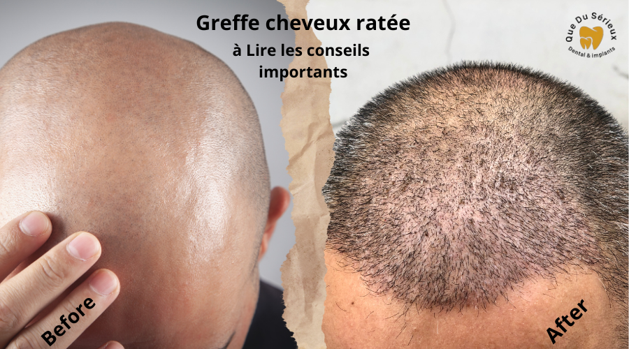 greffe-de-cheveux-ratee